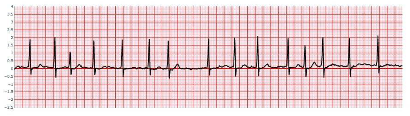 Atrial Fibrillation