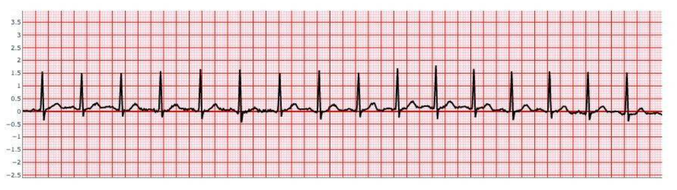 Normal Sinus Rhythm