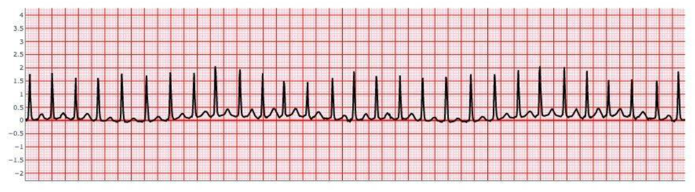 Paroxysmal Supraventricular Tachycardia
