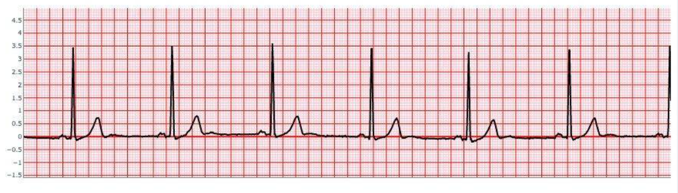 Sinus Bradycardia