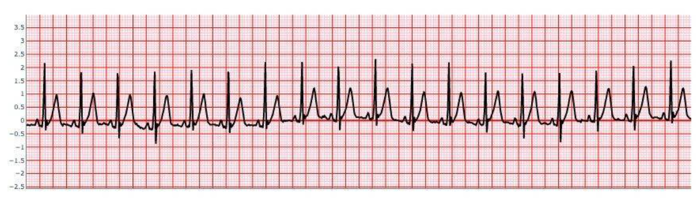 Sinus Tachycardia