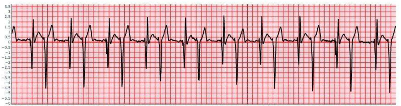 Ventricular Bigeminy
