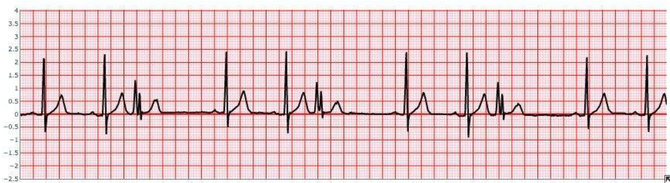 Ventricular Trigeminy